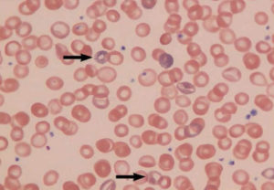 Lead in blood sample