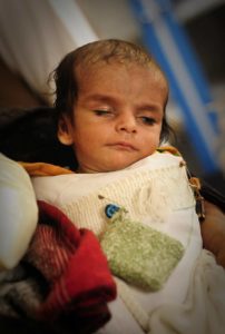 Malnourished Afghan children receive treatment through government feeding program